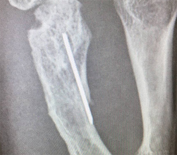 fractura dedo agujas Kisrchnner