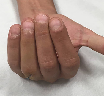 fractura dedos resultado