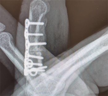 placa para fractura de dedos