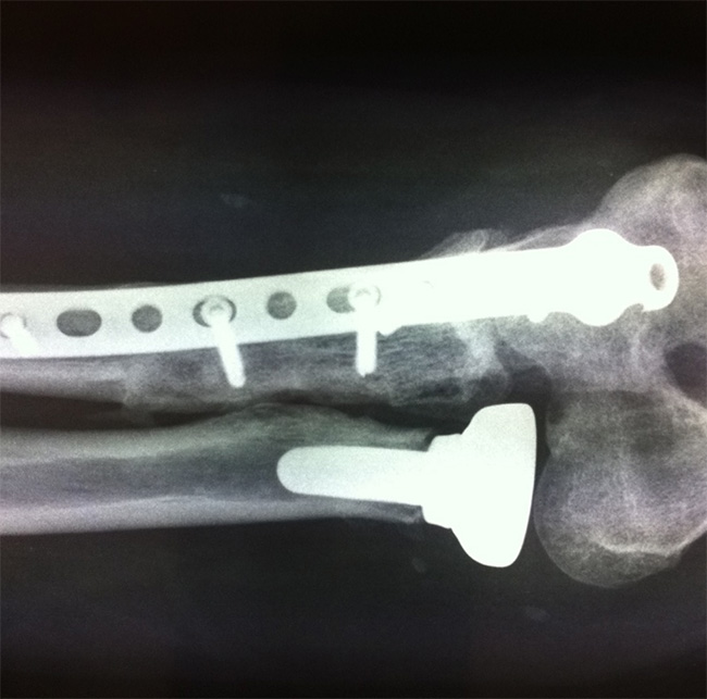 fracturas en traumaunit