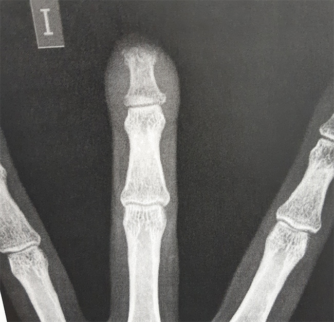 amputación en traumaunit