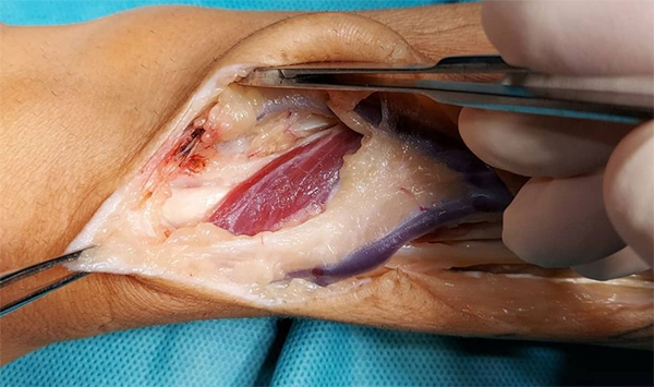 cirugia de mano y muñeca