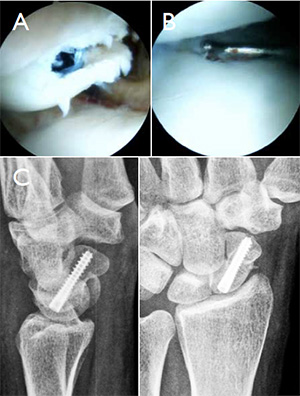 fractura escafoides | tornillo endomedular