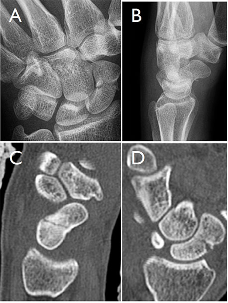 fractura escafoides | tratamiento