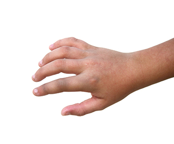 fractura de dedos de la mano