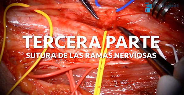 transferencias nerviosas suturas