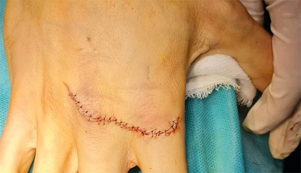 cirugía d ela mano