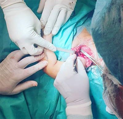 paralisis braquial obstetrica