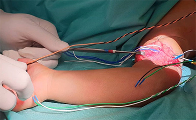 monotorizacion intraoperatoria