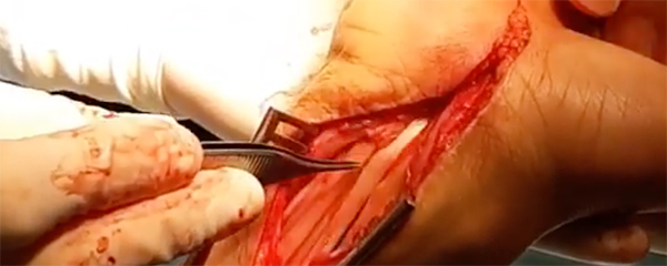 cirugia mano y muñeca