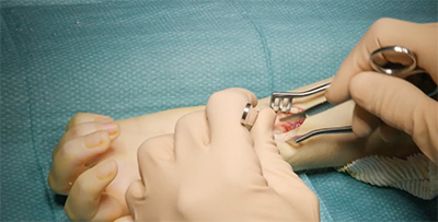 fractura del extremo distal del radio