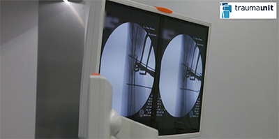 Fractura extremo distal del radio