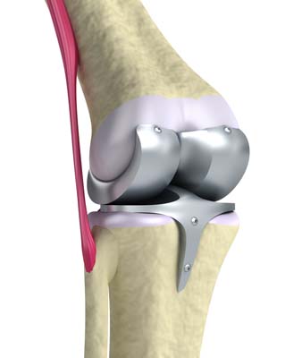 protesis-de-rodilla-imagen-en-3D