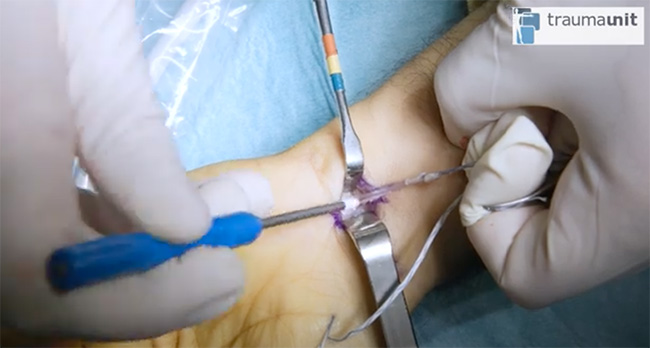 traumaunit ligamentoplastia