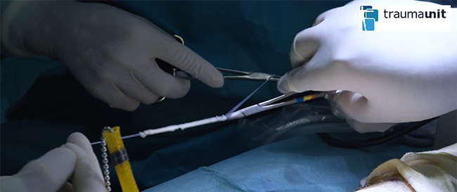 ligamentoplastia en Traumaunit