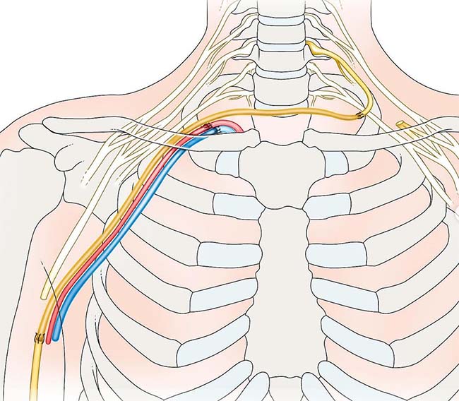 plexo braquial transferencias nerviosas