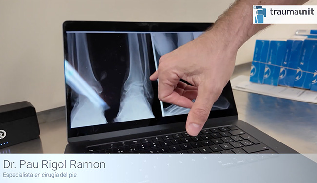 Osteotomia tobillo en varo