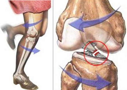 dibujo de rotura de ligamento cruzado anterior