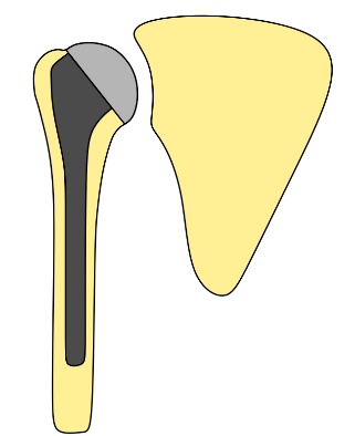 esquema de una articulación